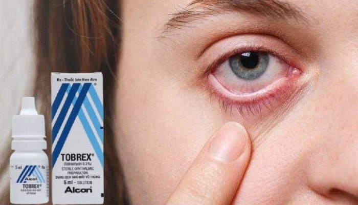 Thuốc Nhỏ Mắt Tobrex Và Tobradex